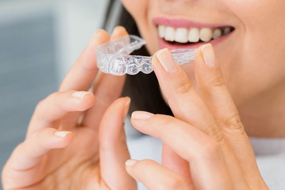 clear aligners